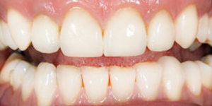 Dental Crowns and Bridges Lauderdale by the Sea FL