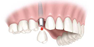 Dental Implants Boca Raton FL