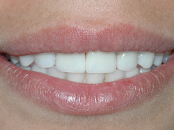 Veneers in Fort Lauderdale