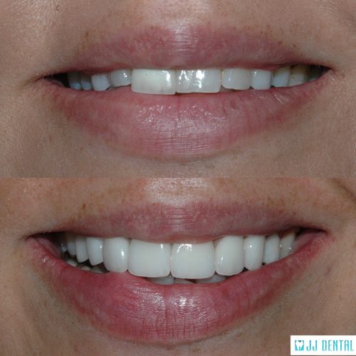 Before & After of 7 Porcelain Crowns and 1 Veneer