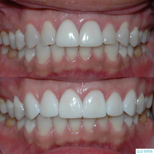 Veneer Revision - Before & After