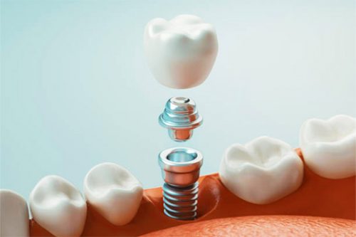 JJ Dental - Dental Implants