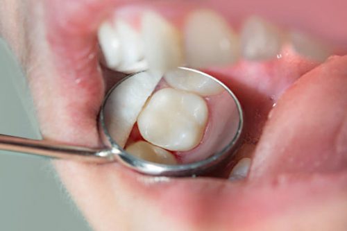 JJ Dental - Tooth-Colored Fillings