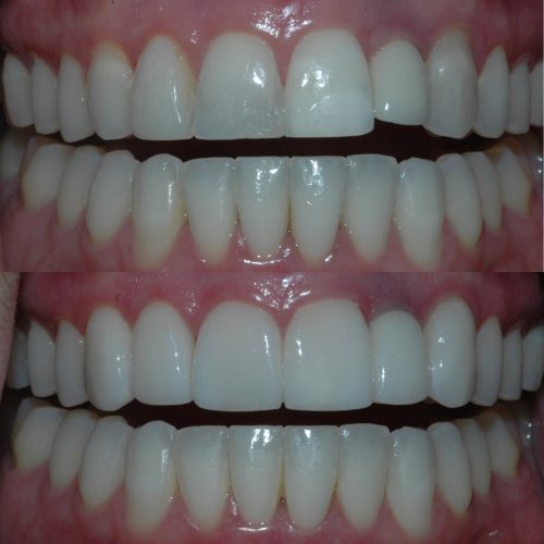 Before & After - Veneers and implant crown replacement