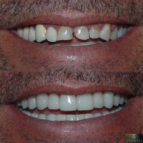 Total Mouth Rehabilitation Before & After