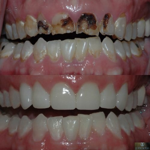 Crowns, Composite, and Bleaching Before & After