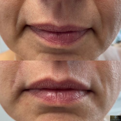 Before & After Juvederm Fillers