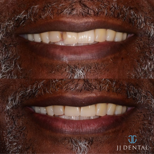 b&a - Dr Jordan - 2 Crowns - Front Teeth 7.26