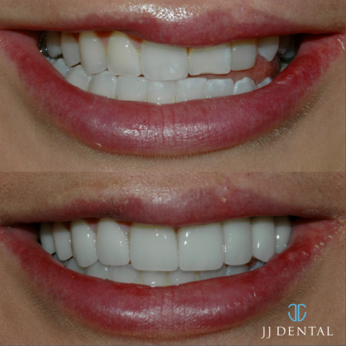 Dr John Smile Makeover Full Mouth Reconstruction