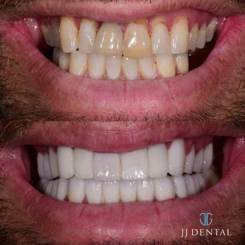 Before & After - Dr Cook - 3 Implants - 25 Porcelain Crowns