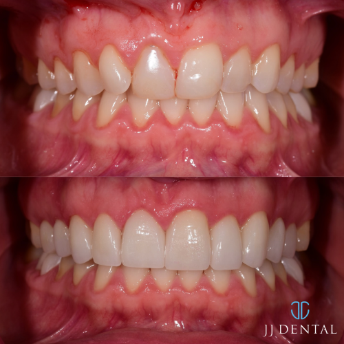 Before & After - Dr Jordan - 10 Veneers - Gum Lift