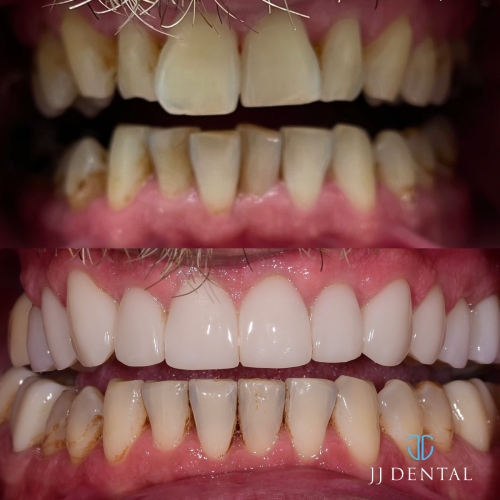 Before & After - Dr. Cook - 2 implants - 4 veneers - 11 crowns
