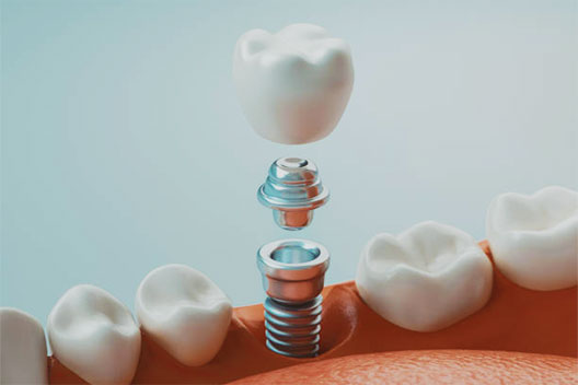 Dental Implants in Fort Lauderdale FL