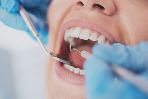 Root Canals in Fort Lauderdale FL