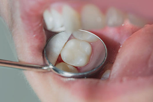 Wisdom Teeth Removal in Fort Lauderdale FL