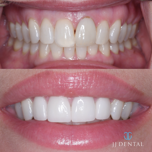 Dr Rudy 4 veneers 1.7.24-1