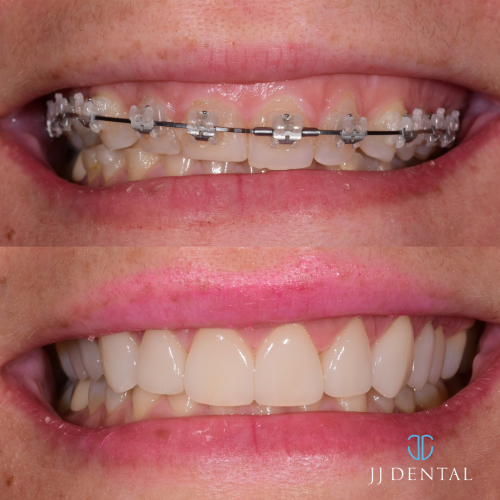 Dr. Cook Braces Orthodontist Gummy Smile 1.7.24-1
