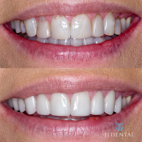 Dr. John 10 veneers best tooth shade 1.7.24-1