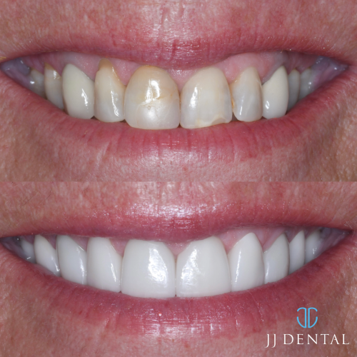 Dr. John 10 veneers in 3 weeks 1.7.24