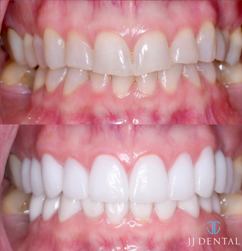 Dr. John 20 Veneers Natural Smile 1.7.24