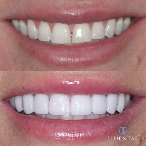 Dr. Rudy 8 Veneers - No gaps or chips. 1.7.24