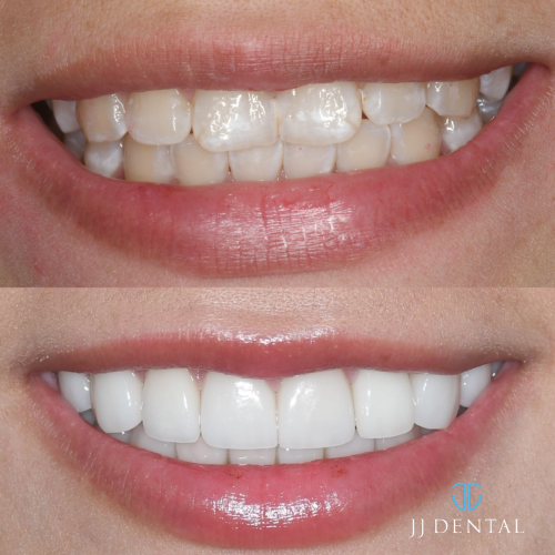 Veneers by Dr. Rudy 1.7.24