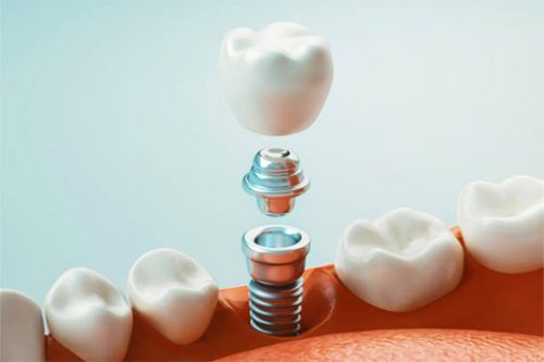 Same Day Teeth Implants Fort Lauderdale