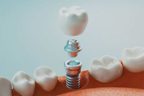 affordable full mouth dental implants Fort Lauderdale