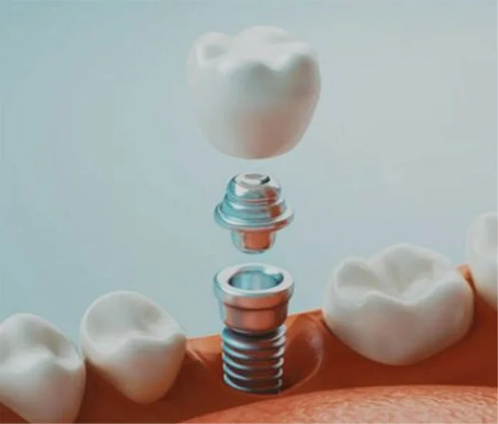 Dental implant components with crown and abutment above natural teeth showing tooth replacement structure