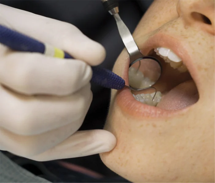 Dentist polishing patient's teeth during professional dental cleaning procedure