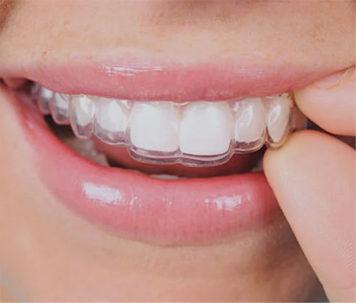 Person wearing clear orthodontic aligner on upper teeth for invisible teeth straightening treatment