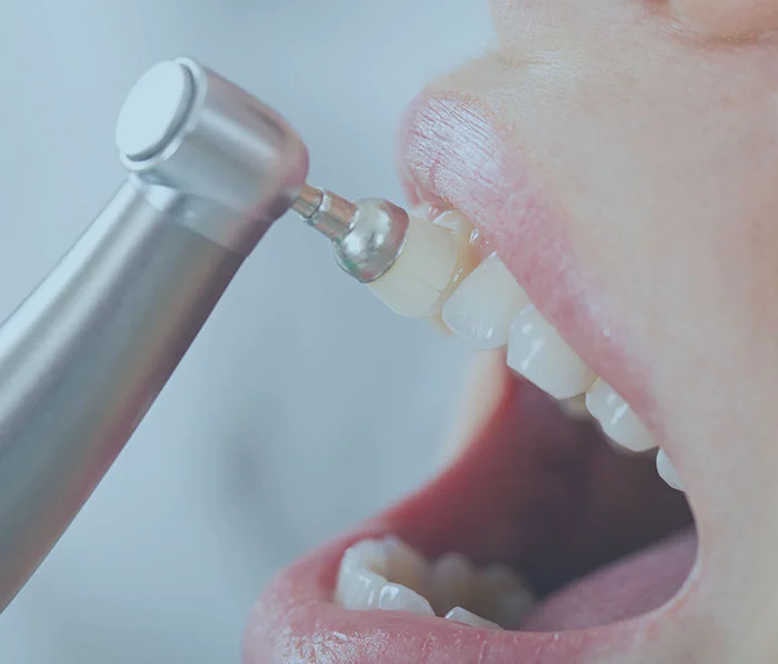 Dental handpiece polishing tooth enamel during cosmetic dentistry procedure at dental clinic