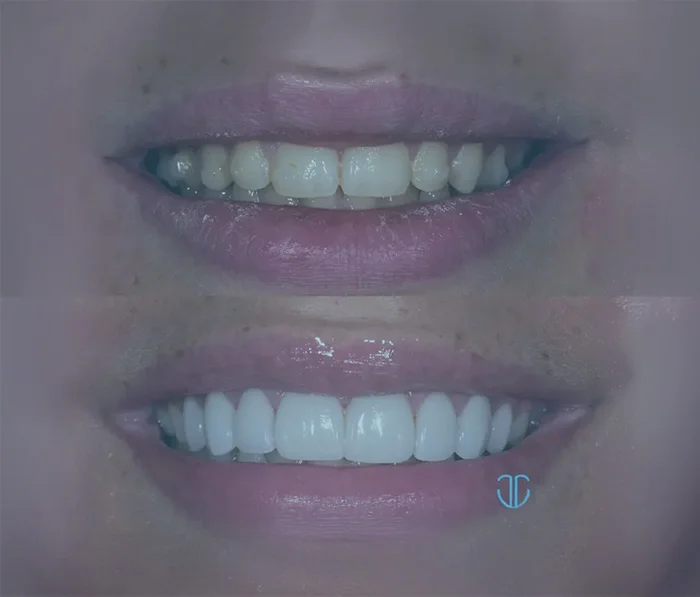 veneers-home