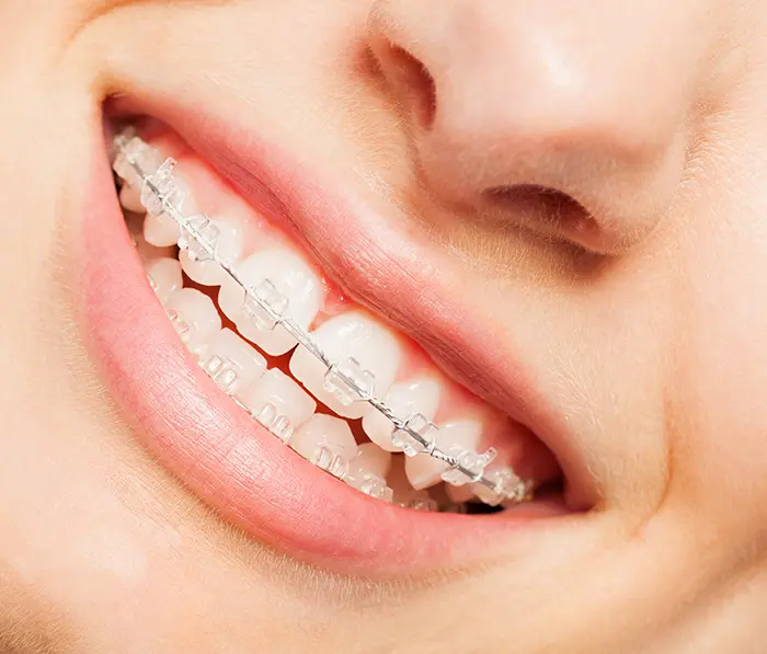 services-braces